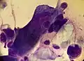 Acantholytic cell and multinucleated giant cell on a smear taken from a vesicular lesion of herpes simplex infection (May-Grünwald Giemsa x1000).