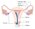 Stage 2 choriocarcinoma