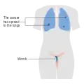 Stage 3 choriocarcinoma