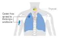 Stage M1 thyroid cancer