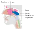 Stage T3 nasopharyngeal cancer