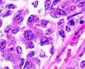 Nuclear grade 3: Markedly enlarged and pleomorphic nuclei, with coarse chromatin and distinct nucleoli.