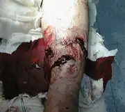 Gustilo type II open fracture