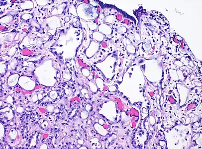 High magnification of the same case, showing the typical features of tubular spaces of varying size composed of flattened cells resembling endothelium.