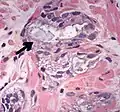 Acinar adenocarcinoma with intraluminal blue mucin.