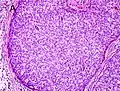 Gleason score 10 (5+5) with solid sheets of cells