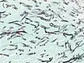 Angioinvasive pulmonary aspergillosis (closeup)