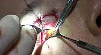 The fat is held with forceps (left), and clamped with a hemostat (right), while a small medical retractor keeps away the extra tissue, so that the surgeon can operate (bottom right).